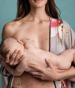 Annelik Estetiği (Mommy Makeover) 2 Annelik Estetiği (Mommy Makeover)